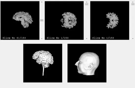Brain and scalp MRI segmentation